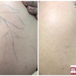 Arm Before and After picture of 2 laser treaments