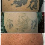 black tattoo on arm laser removed with 4 treatments