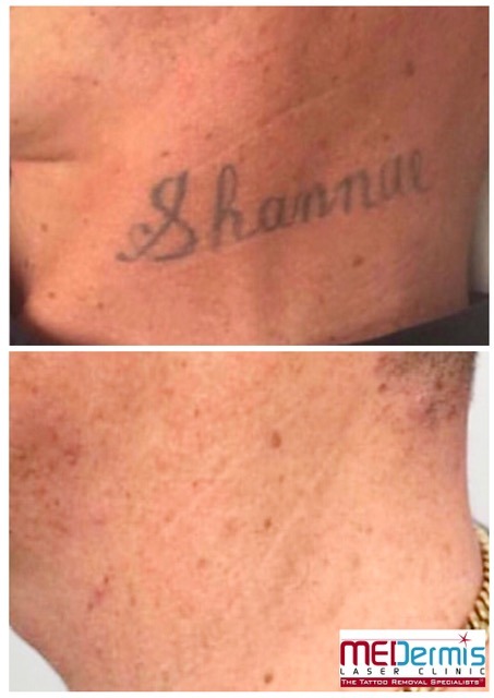 black tattoo on neck laser removed by MEDermis Laser Clinic