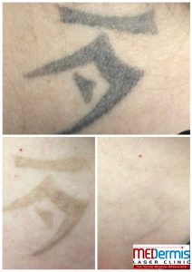 Results of laser tattoo removal of a Chinese character after five treatments