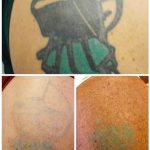 before and after green and black tattoo on arm laser removed in 6 treatments