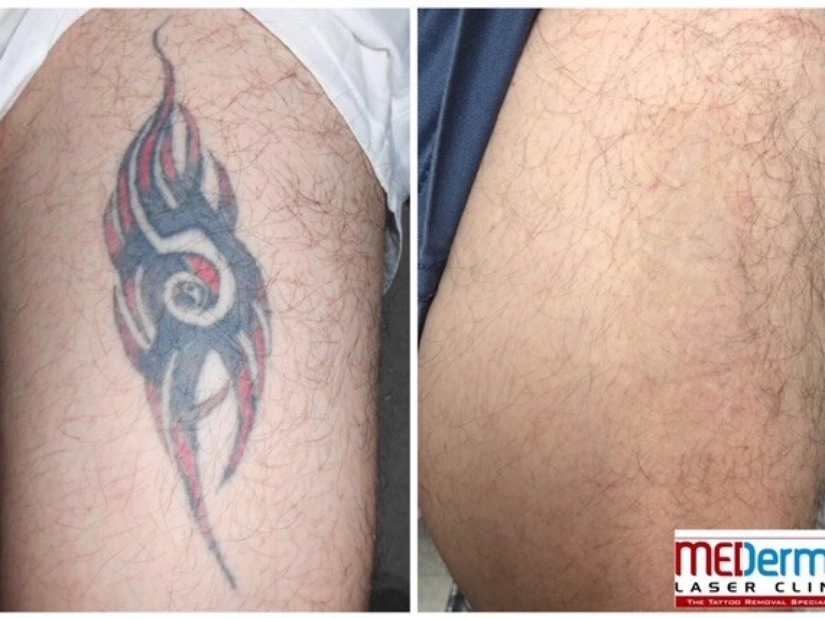Before & After Galleries: A Must Look Before Laser Tattoo Removal