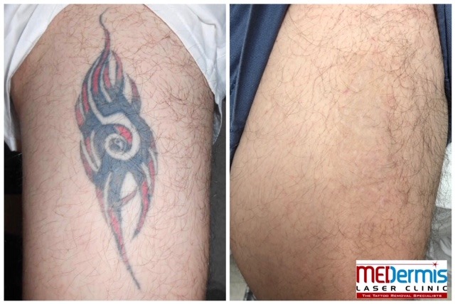 tribal tattoo laser removal results after eight treatments