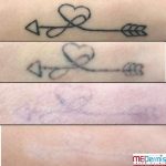 heart and arrow tattoo removal progression in four stages