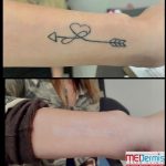 Wrist/arm heart and arrow tattoo removal