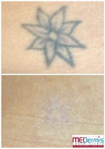 laser removal results of tattoo flower after 9 treatments