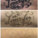 black name tattoo on arm removed by MEDermis tattoo removal