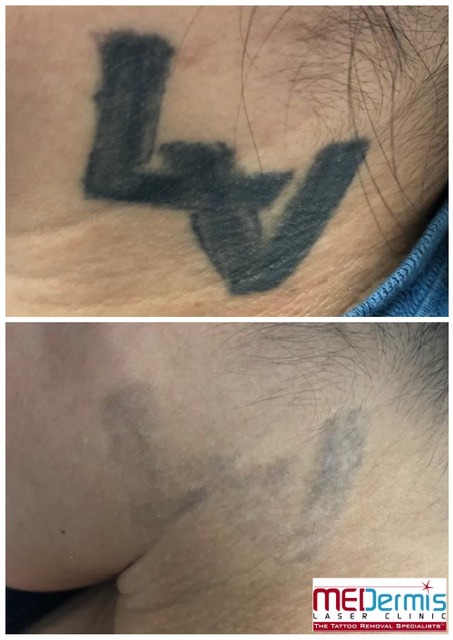 Neck Before and After picture of 10 laser treaments