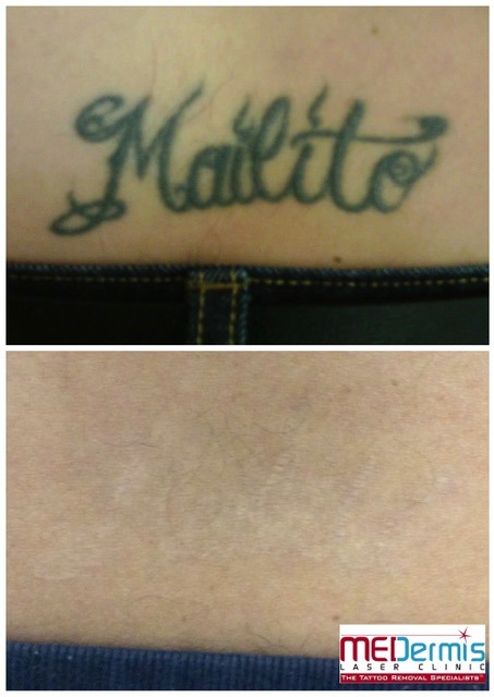 Laser removal of the name Mailito showing results after 14 treatments