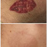 red lips tattoo removal neck