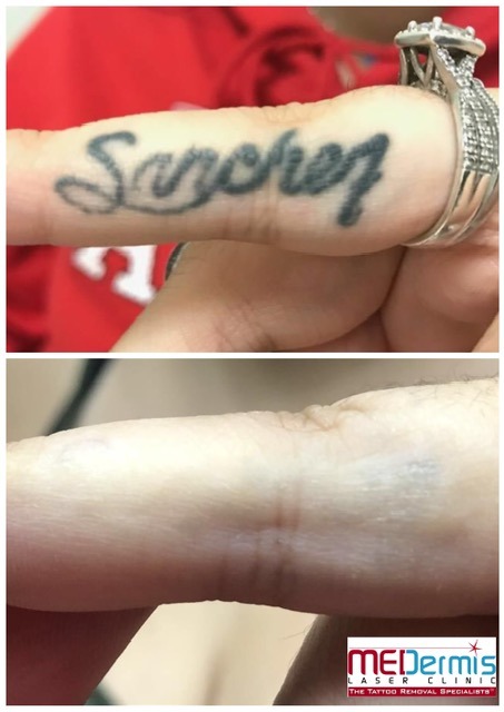 finger tattoo removal