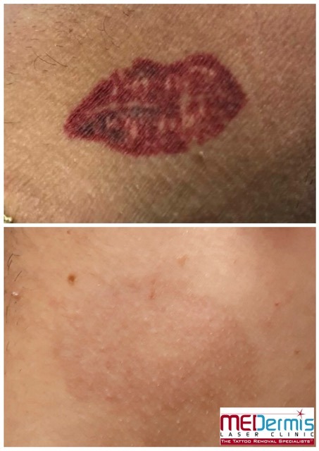 red lips tattoo removal neck