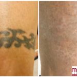 black ankle tattoo removal