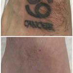 black foot tattoo laser removal