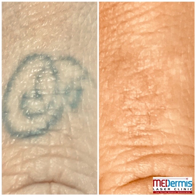black geometric shape outline ring finger tattoo removal before and after