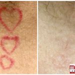 red tatttoo removal by medermis