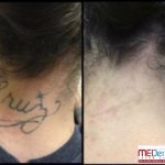 black neck tattoo removal