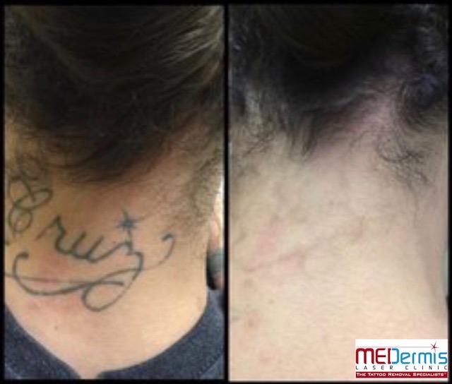 black neck tattoo removal