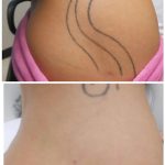 stomach/body tattoo removal before and after
