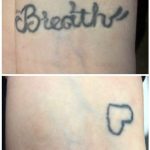 breathe tattoo removal on wrist with heart outline coverup in the after photo
