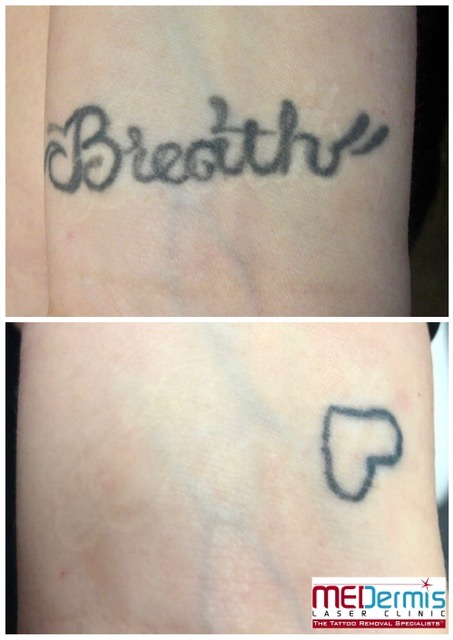 Atme Tattoo-Entfernung am Handgelenk mit Vertuschung des Herzumrisses auf dem Nachher-Foto
