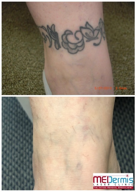 black ankle flower and butterfly tattoo removal