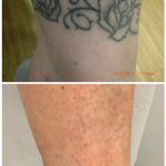 black ankle floral tattoo removal before and after