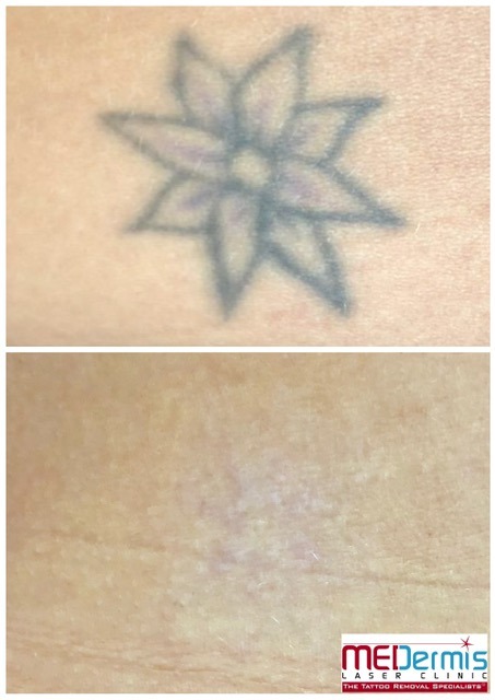 simple flower outline tattoo removal