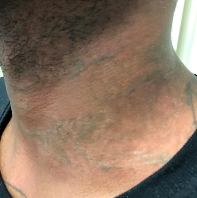 dark skinned neck with faint blue traces of previous tattoo