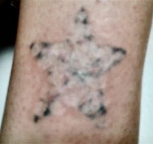 side of ankle with a blotchy star tattoo, showing black spots and skin