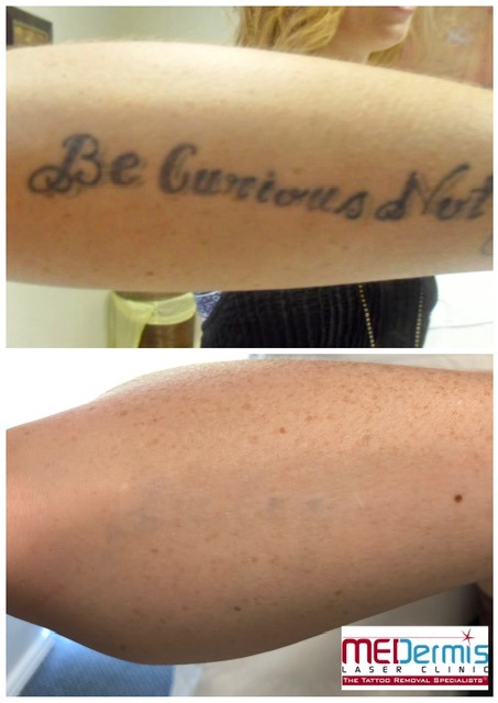 be curious word tattoo removal on forearm