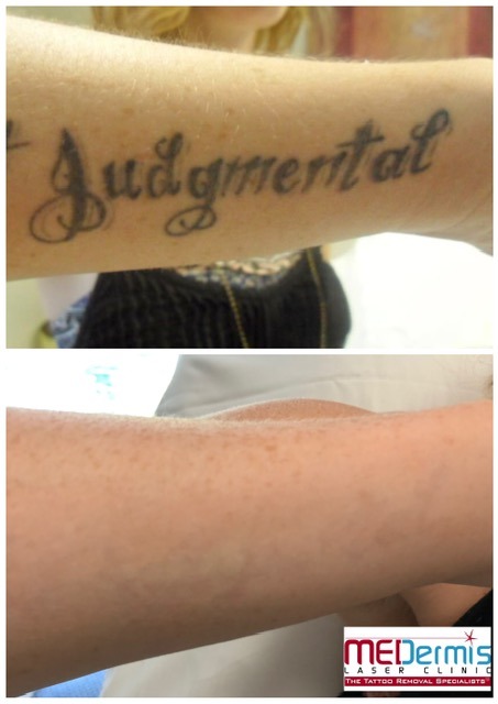judgmental word tattoo removal on forearm