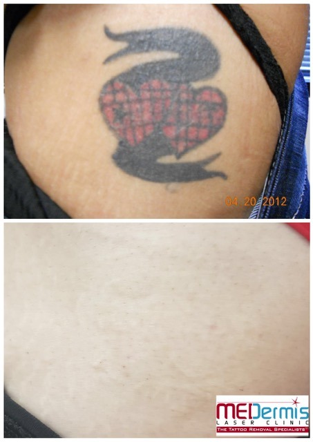 two red checkered hearts in front of a black banner tattoo removal