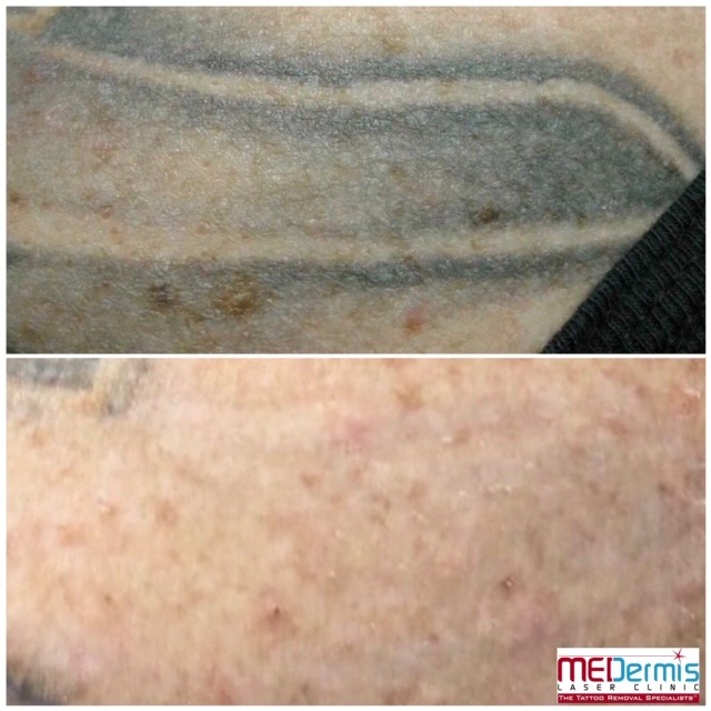 black shaded tattoo removal before and after