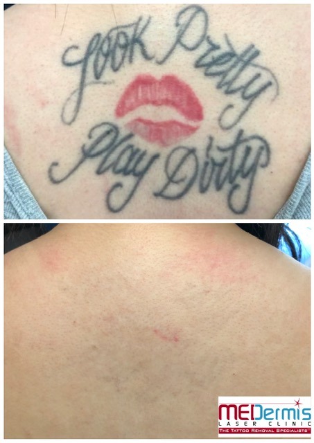 look pretty play dirty kiss tattoo removal before and after