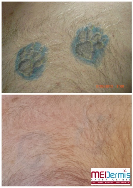 two paw prints outlined in blue tattoo removal on hairy skin