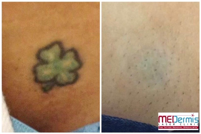 green four leaf clover with black outline tattoo removal