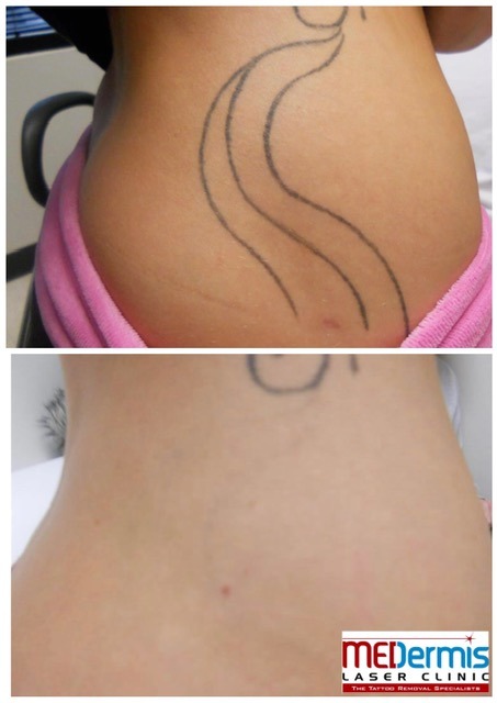 wavy lines tattoo removal hip before and after
