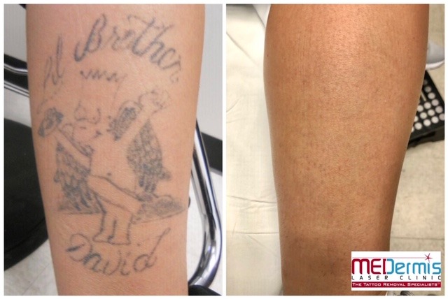 winged bart simpson tattoo removal before and after