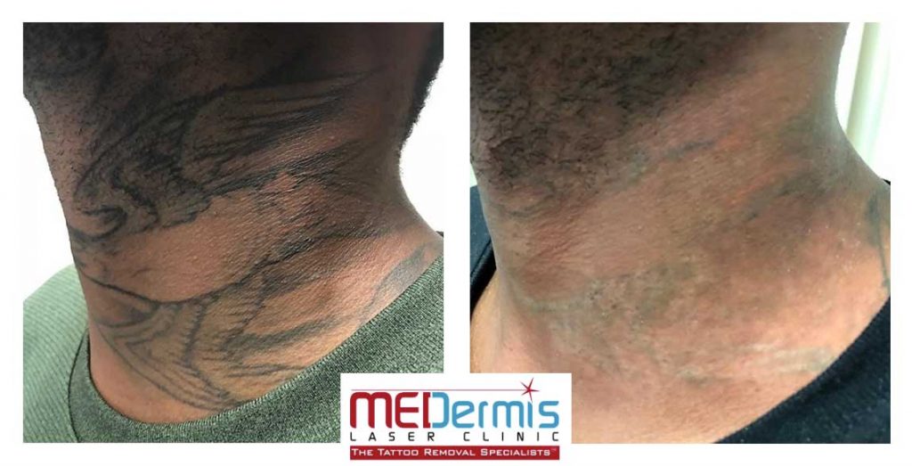 Neck & Face Laser Tattoo Removal Before & After Results | MEDermis