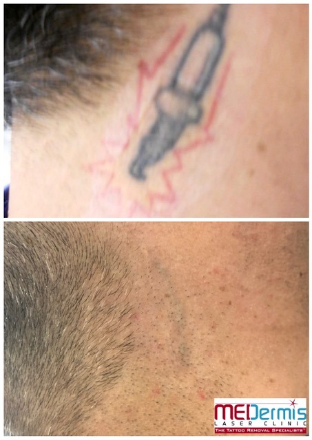 black shaped tattoo with red outline tattoo removal