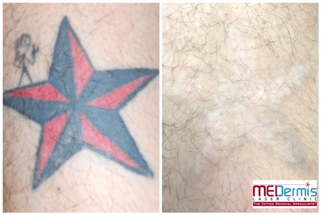 black and red star with stick figure person tattoo removal before and after