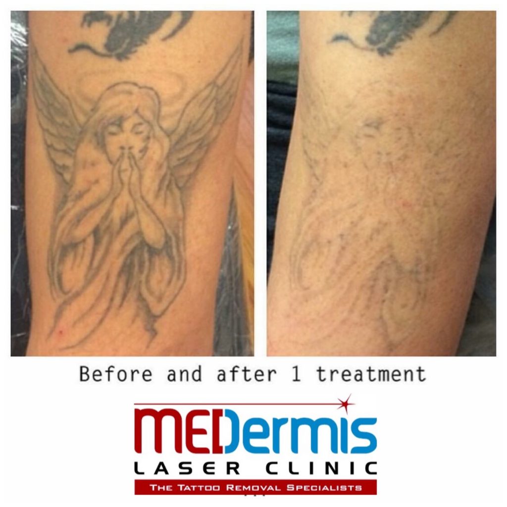 1 session laser tattoo removal