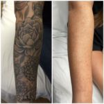 10 Laser tattoo removal treatments