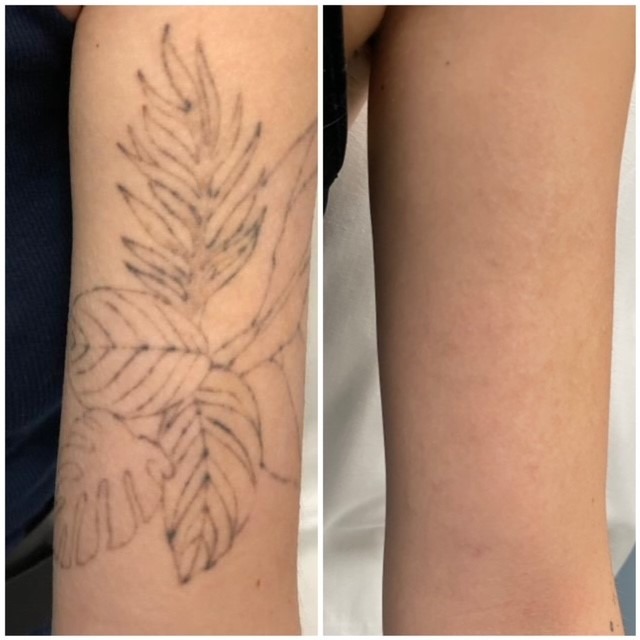 4 Laser tattoo removal treatments